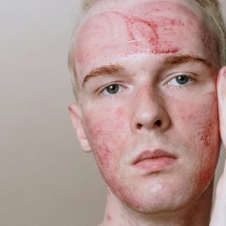 Pros And Cons Of Vampire Facial in Dubai?