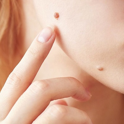 Pros and Cons of Mole Removal in Dubai & Abu Dhabi Cost