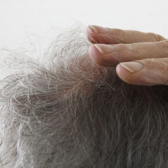 Regenera Activa and Micrograft Treatment Dubai