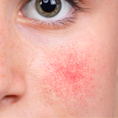 What Causes Capillaries to Appear on the Face?