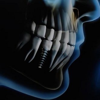 What To Expect During a Dental Implant Treatment?