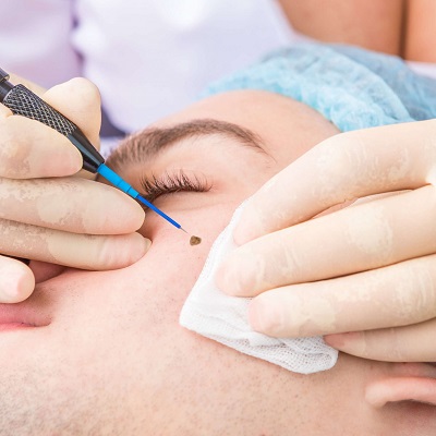 What do Dermatologists Use To Remove Moles in Dubai & Abu Dhabi