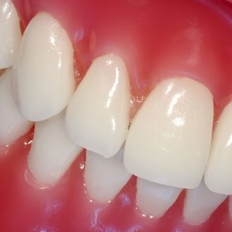 What is the Cost of Pink Gums with Laser in Dubai