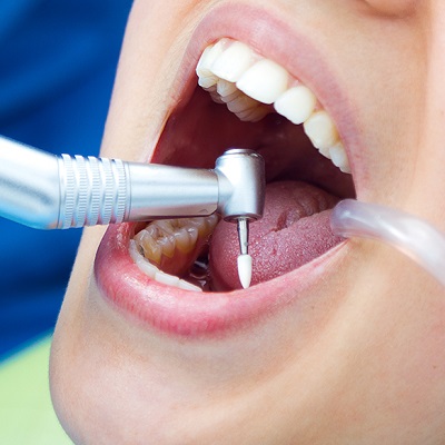 Why Do We Need Root Canal Treatment in Dubai & Abu Dhabi Price