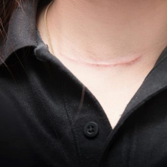 8 Things to Know Before Getting Laser Scar Removal