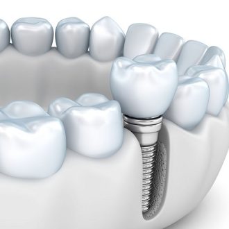 Benefits of Dental Implant in Dubai & Abu Dhabi