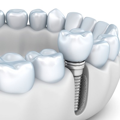Benefits of a Dental Implant in Dubai & Abu Dhabi Cost & Price
