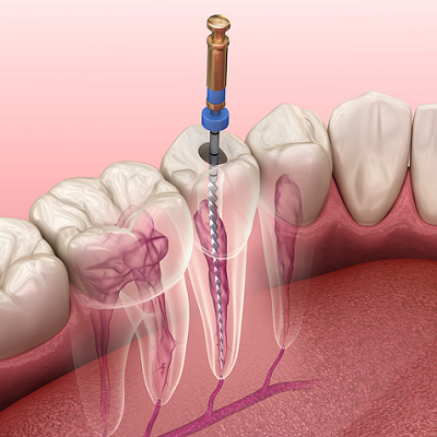 Different Types Of Root Canal Treatment in Dubai