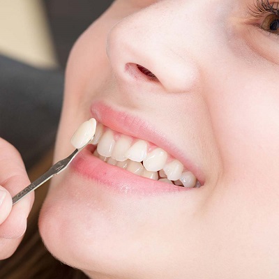 Enhance Your Smile With Natural Veneers in Dubai & Abu Dhabi Cost