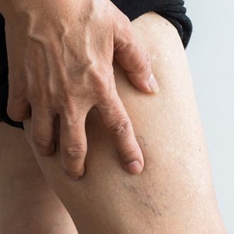 How Do I Get Rid of Spider Veins on My Face?