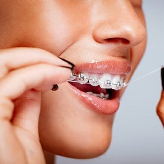 How Do I Go for the Teeth Braces Suited for Me?