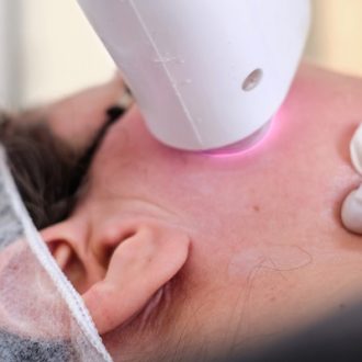 How To Get Rid Of Melasma Permanently in Dubai