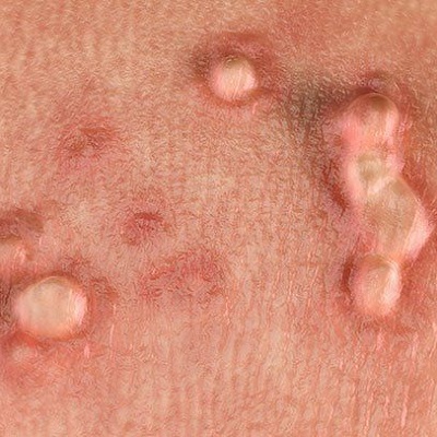How To Get Rid of Genital Warts in Dubai?