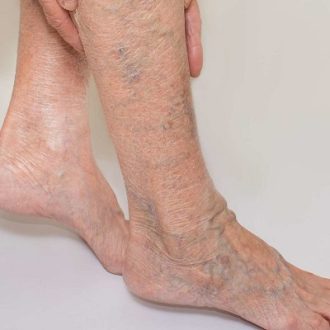 Is Varicose Vein Treatment Safe?