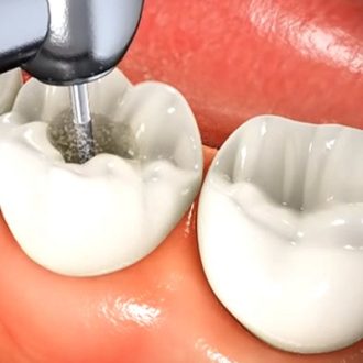 Painless Single Sitting Root Canal Treatment