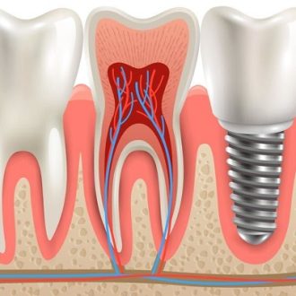 Save your Natural Teeth with Root Canal Treatment