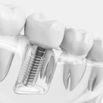 Type of Dental Implant And How Does It Work?