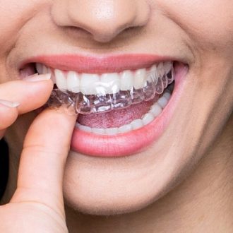 What Are The Benefits of Aligners in Dubai?