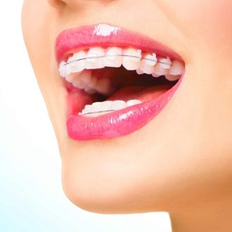 What Are the Risks of Ceramic Braces in Dubai?