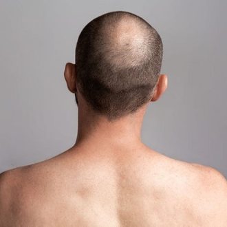 Which Treatment Is Best For Bald Head in Dubai?