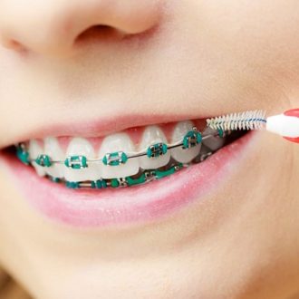 10 Important Things to Know Before You Get Dental Braces