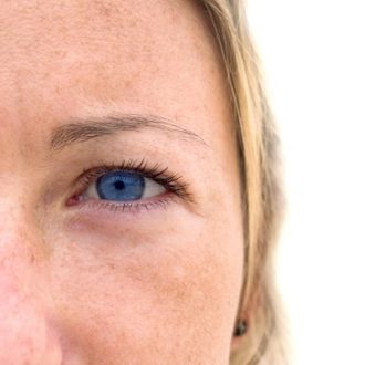 All You Need To Know About Eyelid Surgery in Dubai