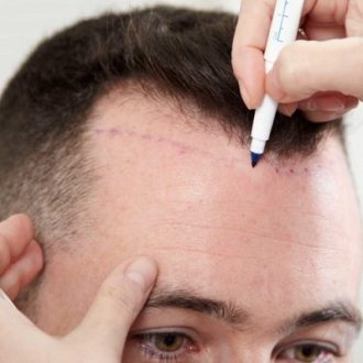 Bio-Enhanced FUE & FUT Hair Transplant in Dubai