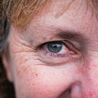 Causes of Melasma in Females and Males