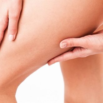 Cool Beam Laser Stretch Mark Removal in Dubai