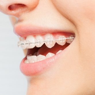 Enhance Your Smile with Ceramic Braces in Dubai