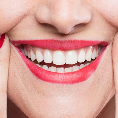 Everything You’ve Ever Wanted to Know About Hollywood Smile in Dubai