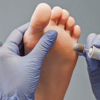 Feet Warts Removal Treatment In Dubai