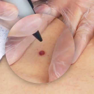 Hemangioma Treatment for Adults in Dubai