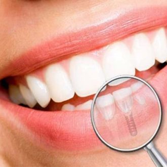 How Long do Dental Implants Last in Dubai