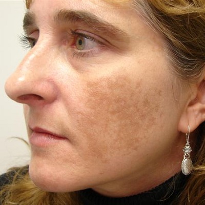 How To Cure Melasma From The Inside in Dubai