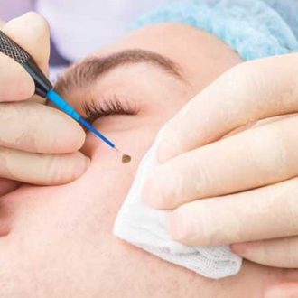 How is Cryosurgery Performed in Dubai?