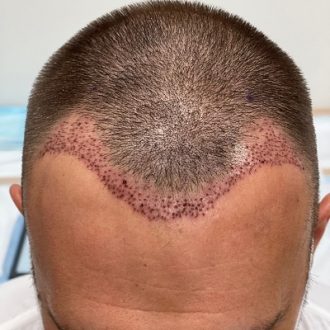 Is Hair Transplant Cheap in Dubai & Abu Dhabi
