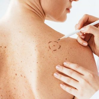 Mole Removal in Dubai Jumeirah