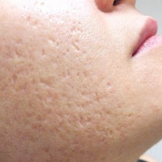 Open Pores Treatment in Dubai & Abu Dhabi
