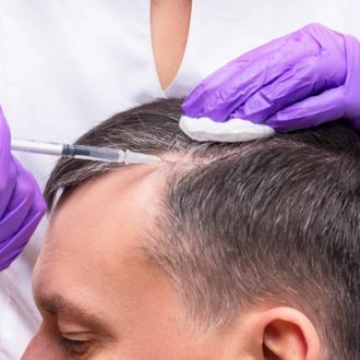 PRP And PRF Hair Restoration in Dubai