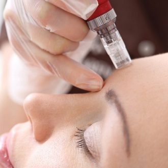 PRP Microneedling for Hyperpigmentation in Dubai