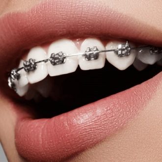 Perfect Your Smile with Braces in Dubai & Abu Dhabi