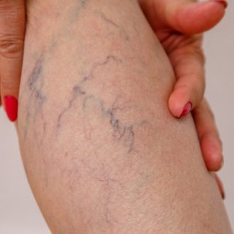 Should I Worry About Varicose Veins in Dubai
