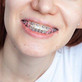 Straighten Your Smile With Ceramic Braces