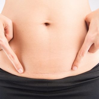 What Type of Surgery is Surgical Scar Revision?