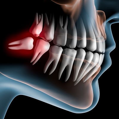 When to Get Wisdom Teeth Removed in Dubai