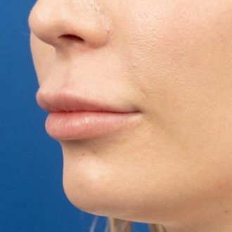Benefits of Lip Reduction in Dubai & Abu Dhabi