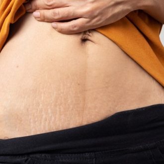 CO2 Laser For Stretch Marks in Dubai & Abu Dhabi