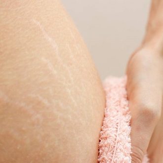 Can You 100% Get Rid of Stretch Marks in Dubai?
