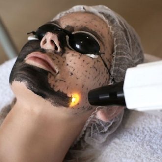 Carbon Laser Peel For Pigmentation Treatment